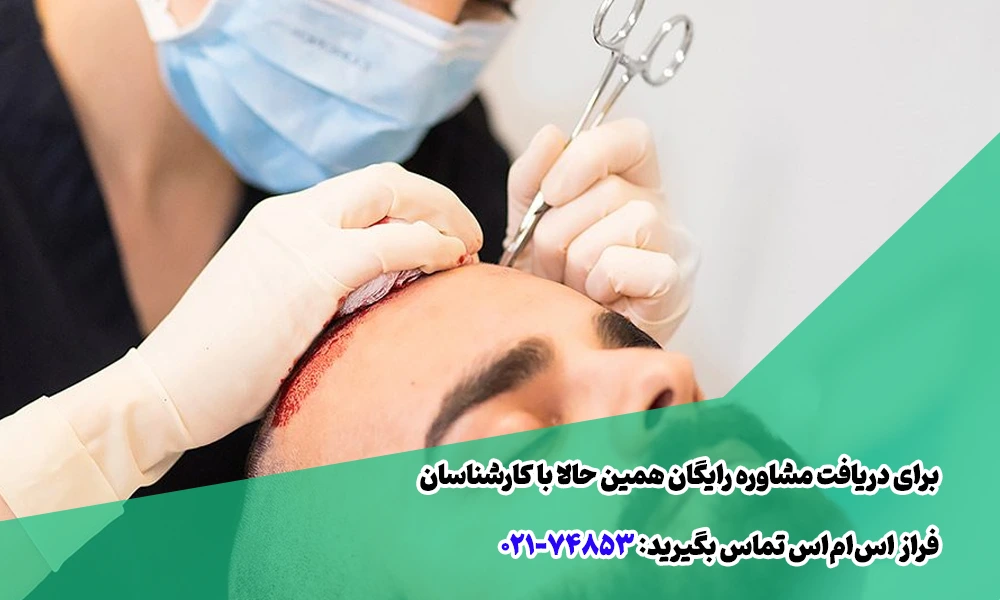 تبلیغات پیامکی کاشت مو